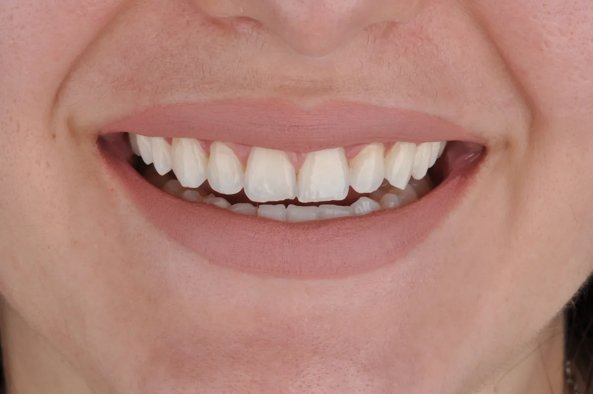 dentes com o uso do clareador dental whiteness perfect 22%