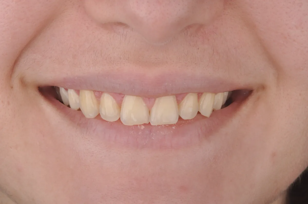 dentes sem o uso do clareador dental whiteness perfect 22%