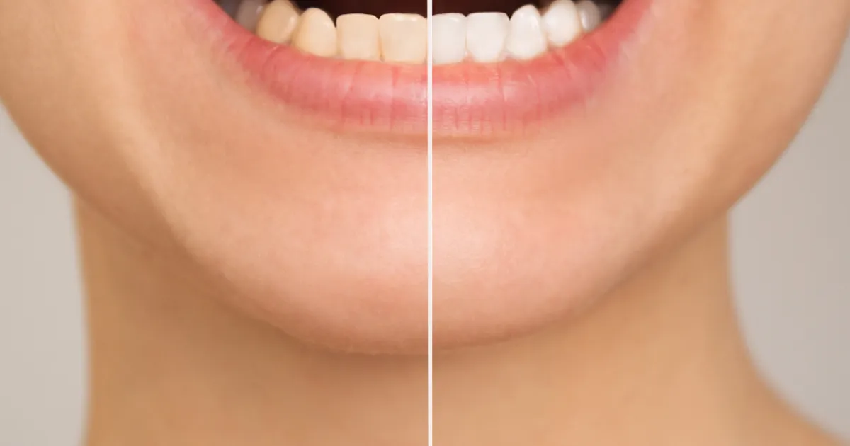 Clareamento dental gradual: por que essa abordagem é a preferida para quem busca segurança