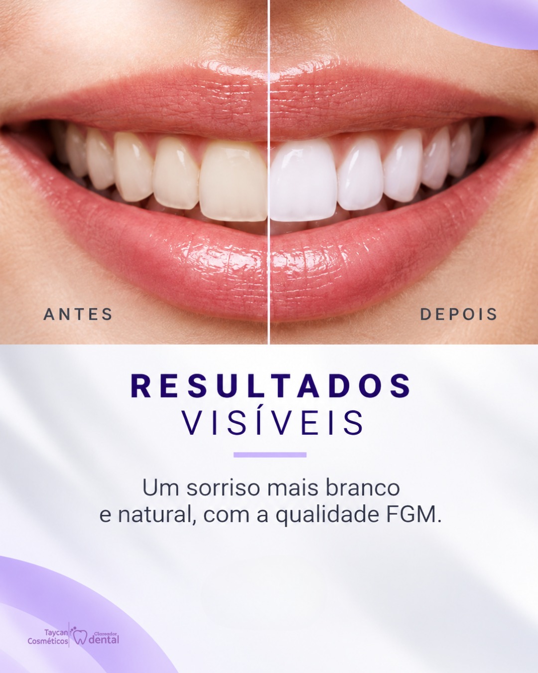 Post do Instagram: Resultados que aparecem no sorriso. 💜 O clareamento dental pode contribuir para uma aparência mais clara e uniforme dos