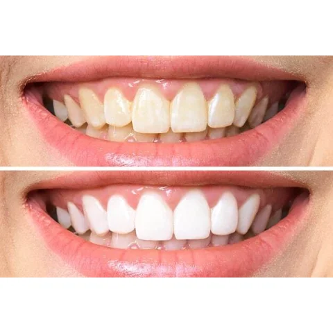 Clareador Dental White Class 7,5% FGM, 1 seringa – imagem 4 do produto
